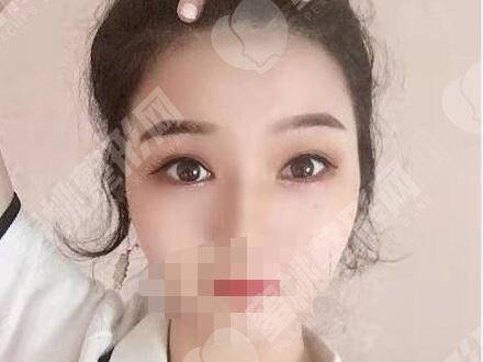 双眼皮r术后30天