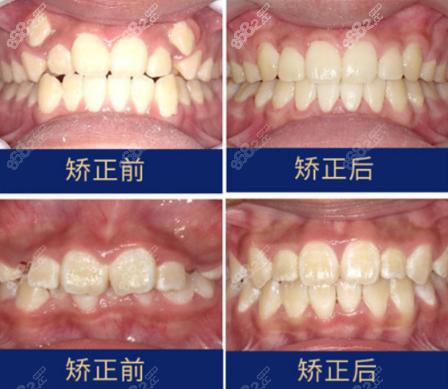 牙槽骨矫正需要多少钱