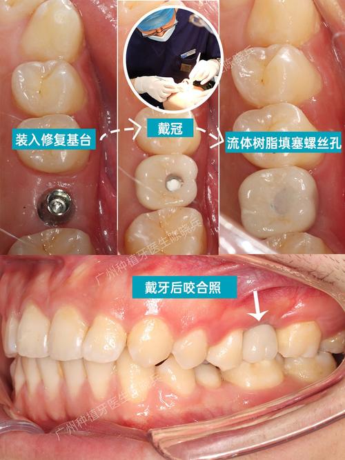 种植牙愈合基台和永久基台的区别—种植牙