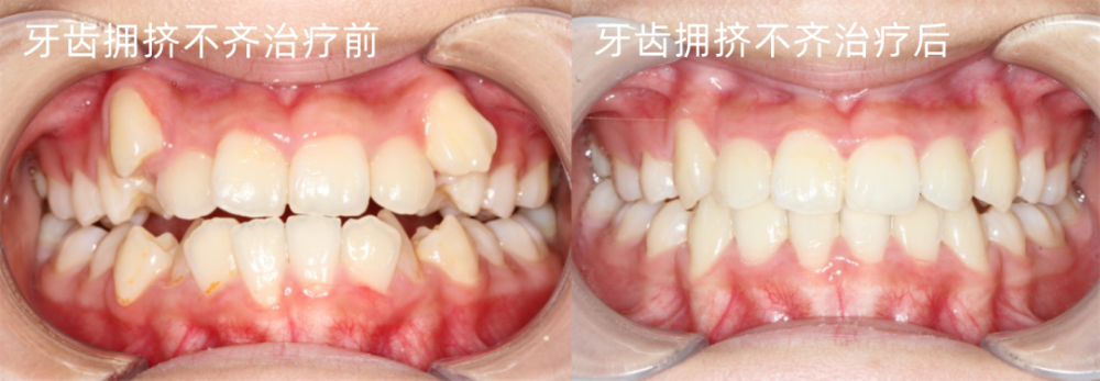 牙齿正畸后，注重牙垫高的重要性