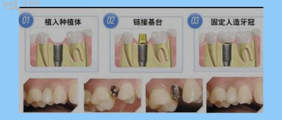 微创种植牙的价格