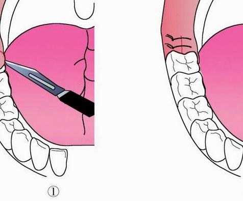 智齿冠周瓣切除手术