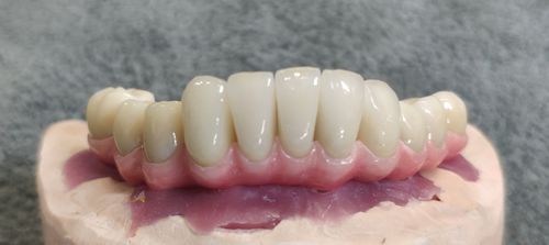 种植牙半口桥架