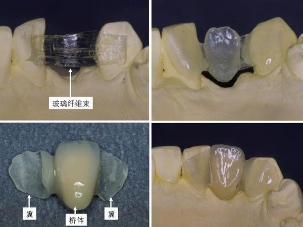 联冠修复和固定桥