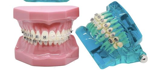 牙齿固定矫正器图片