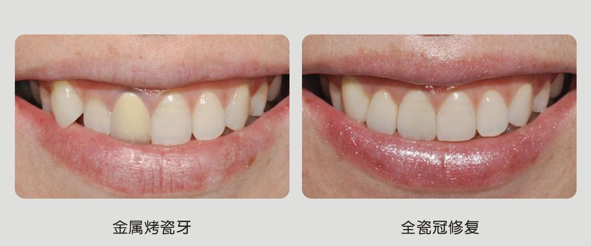 美容冠矫正牙齿效果好不好