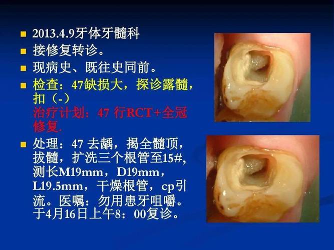 根管口名词解释