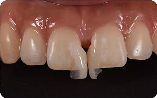 瓷贴面牙冠可以维持多久呢