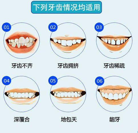 暴牙齿怎么矫正多少钱