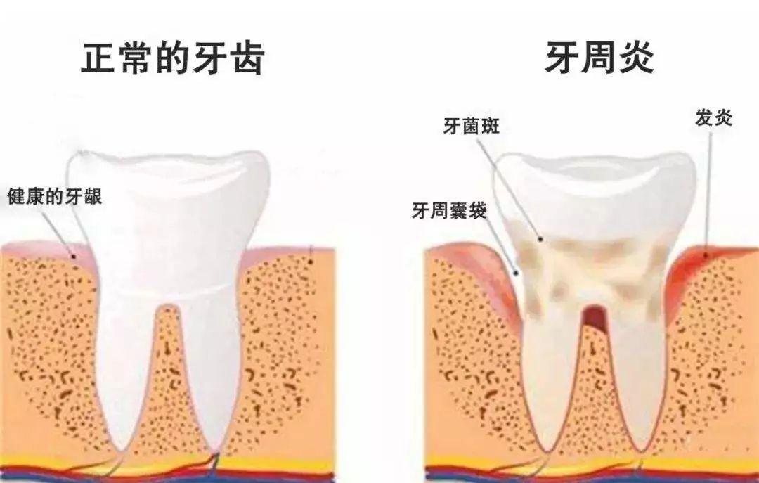 牙周组织重建术的适应症