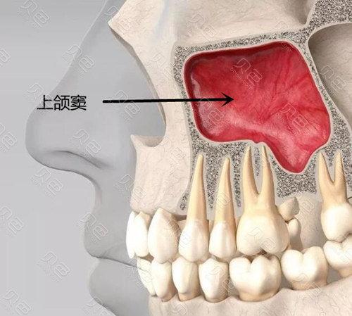 上颌窦窦口开放后