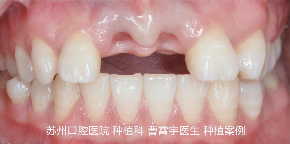 种牙微创手术后多久恢复