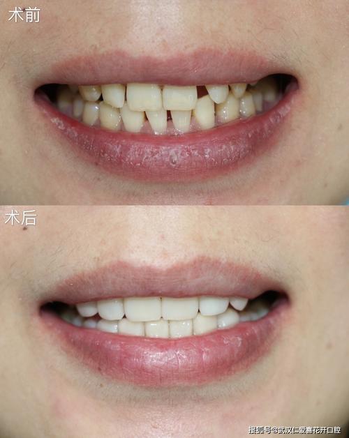 瓷贴面牙冠可以维持多久呢