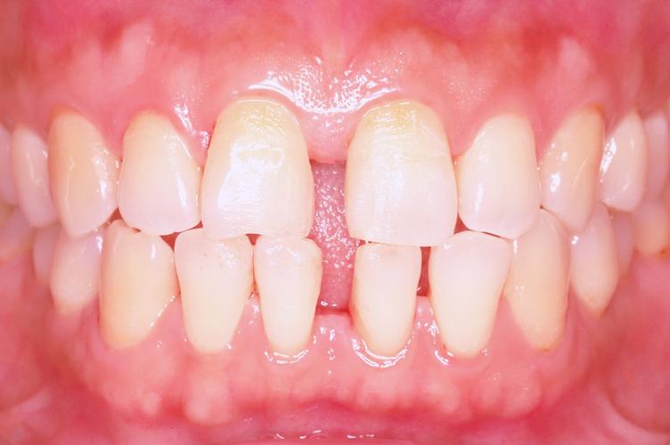 门牙牙缝大修复估计要多少钱—门牙牙缝大修复