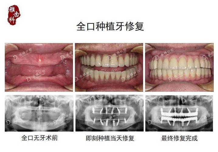 自体牙移植术