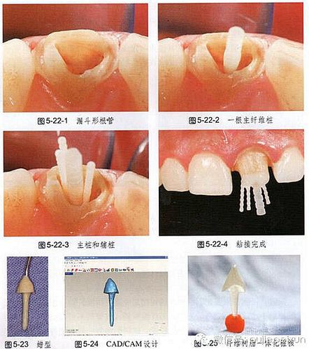 纤维桩和全瓷桩的区别