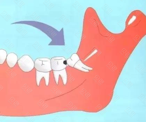 智齿阻生齿拔牙多少钱