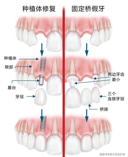 半口种植修复流程