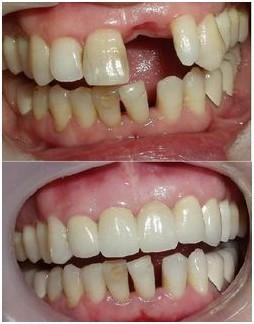 门牙松动怎么办