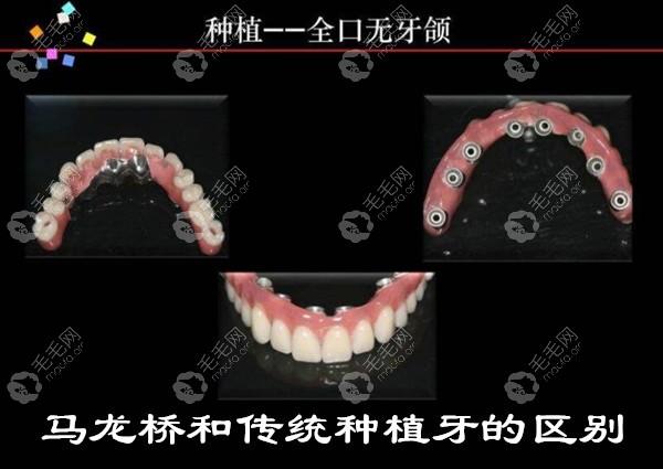 马龙桥种植牙缺点