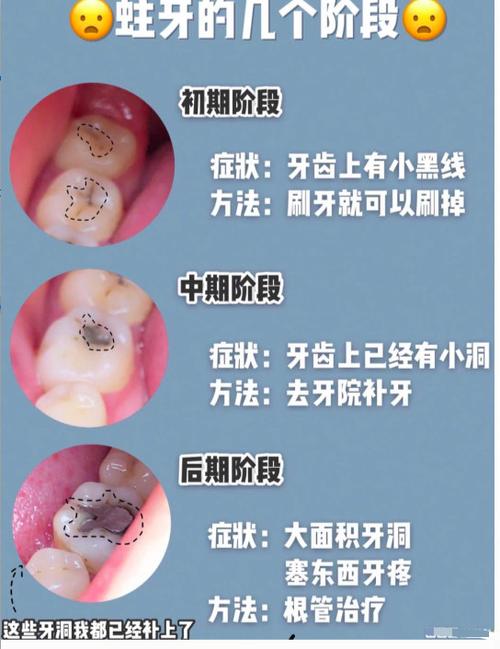 龋洞引起牙痛怎么办