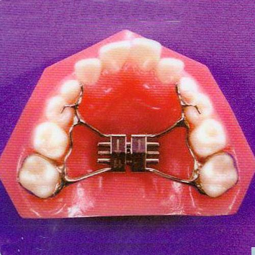 矫正牙齿扩弓的利弊