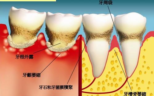 水激光治疗牙周炎的利弊