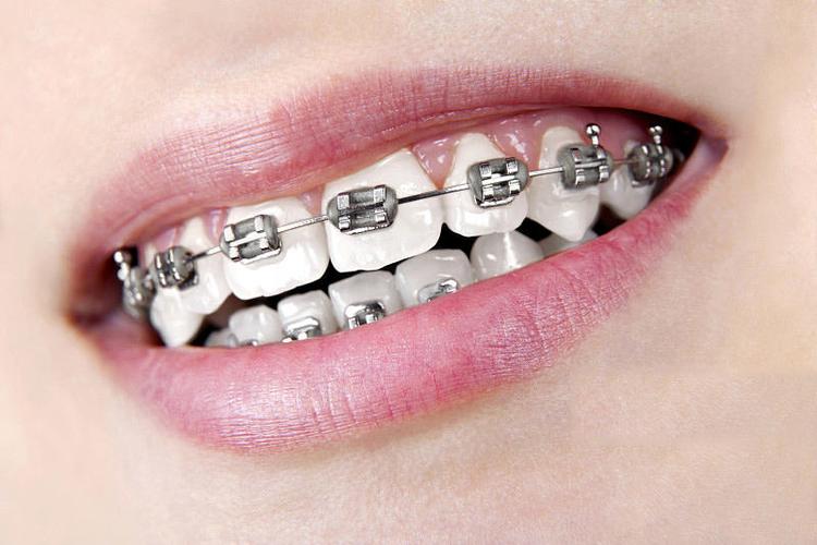 矫正面弓图片效果图