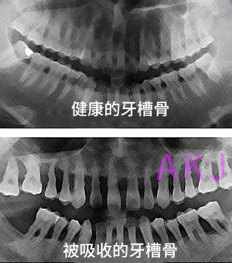 牙槽骨吸收