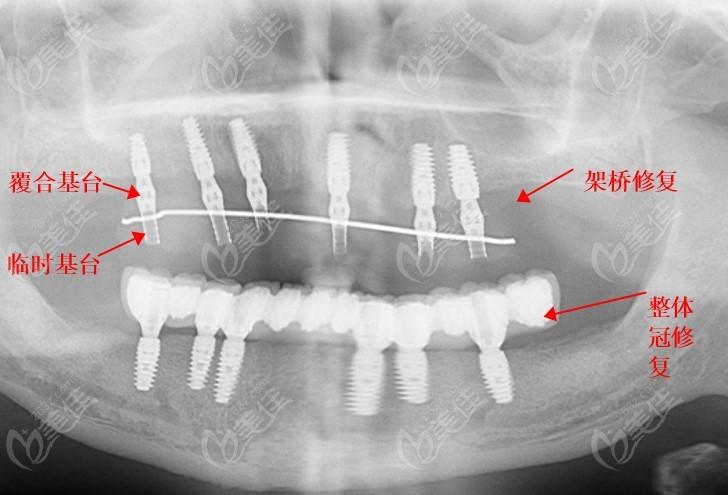 种植牙半口桥架