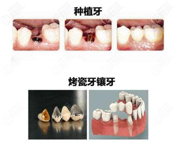 微创种牙还是传统种牙