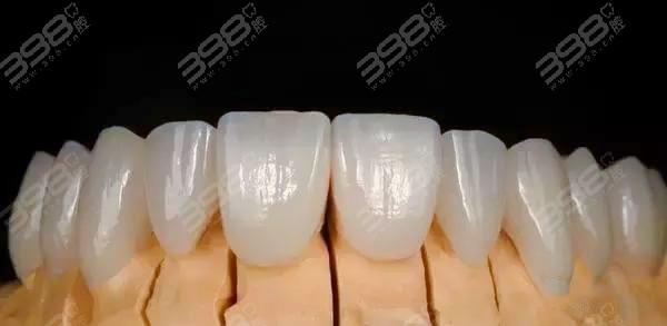 纯钛合金烤瓷牙和3d烤瓷牙的区别