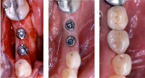 种牙微创手术后多久恢复