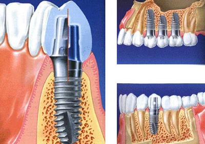 牙龈萎缩种植牙