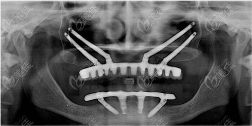 种植牙穿颧有没有后遗症