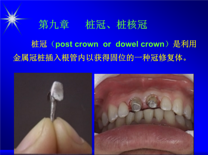 柱冠修复与种植