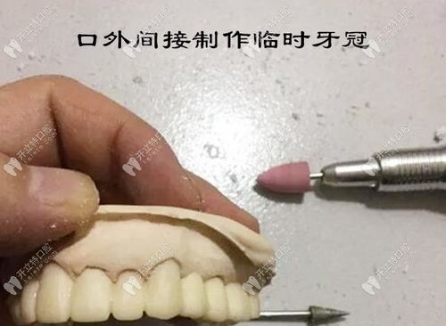 牙齿临时冠制作视频