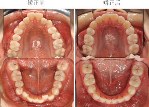 骨性前突深覆合