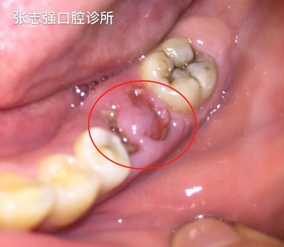 解决断牙残根疼痛的有效方法