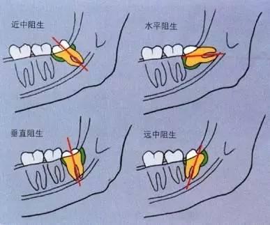 骨性埋藏与阻生牙的区别分析