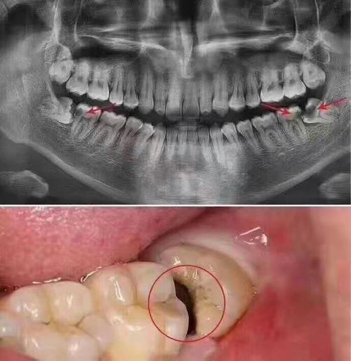 智齿高位近中阻生齿容易拔吗