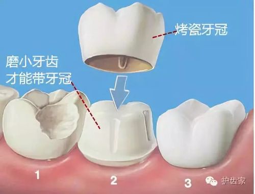 种植牙固定桥戴牙步骤