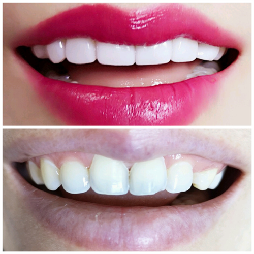 纳米齿雕和冰瓷牙贴面哪种好