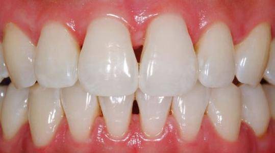 黑三角补牙龈膜龈手术副作用—黑三角补牙手术