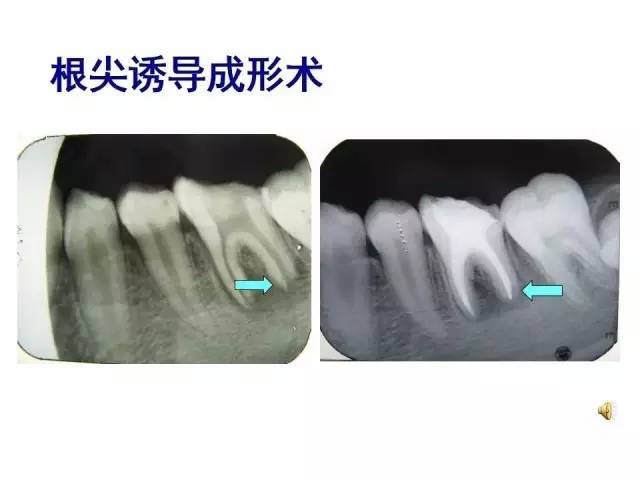 牙根尖诱导术