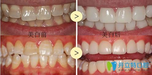 牙齿冷光美白和贴面哪个效果好