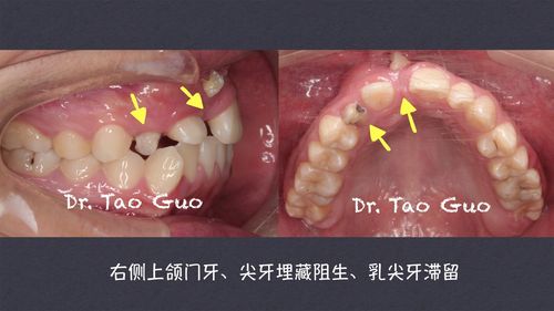 骨性埋藏与阻生牙的区别分析