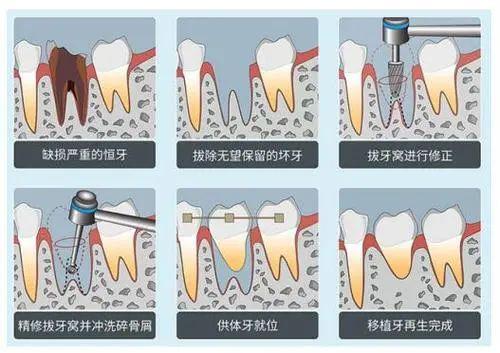 牙体修复步骤