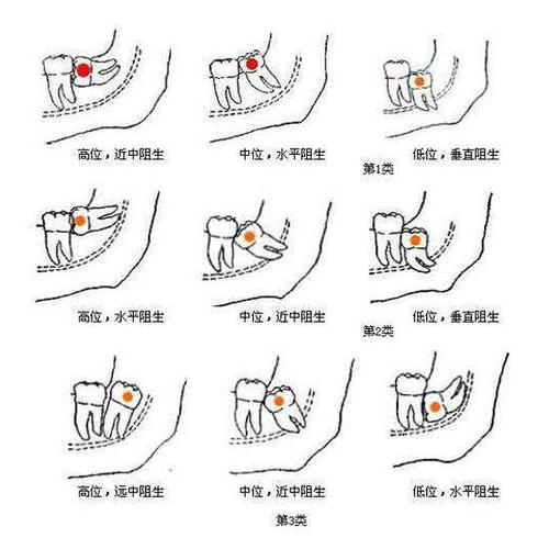 骨性埋藏与阻生牙的区别分析