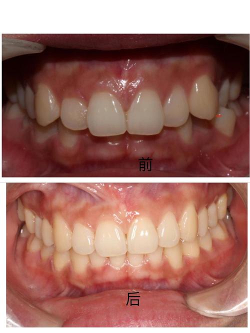 智齿歪斜正畸能矫正吗